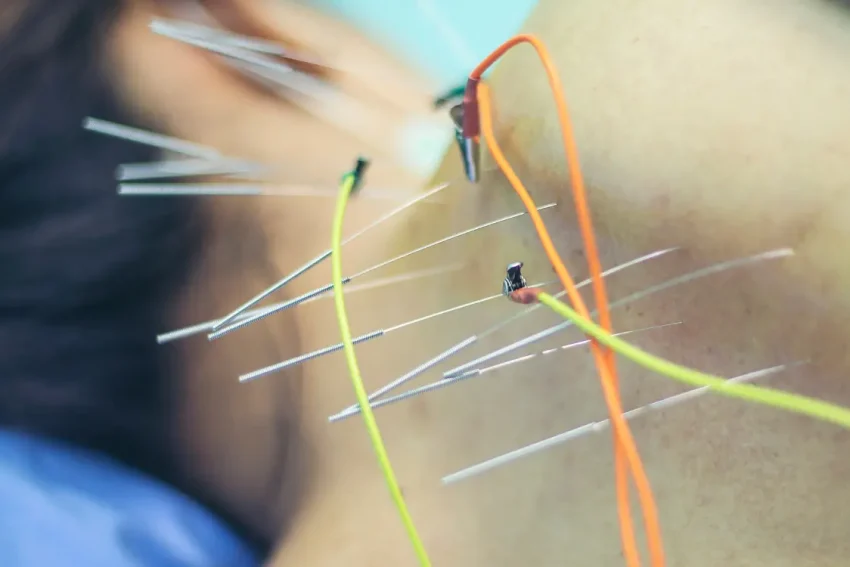 Image of Dry Needling therapy treatment at our Chandigarh-based life physiotherapy clinic