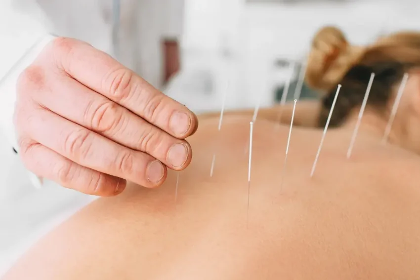 Image showcasing Acupuncture therapy at our Chandigarh-based life physiotherapy clinic