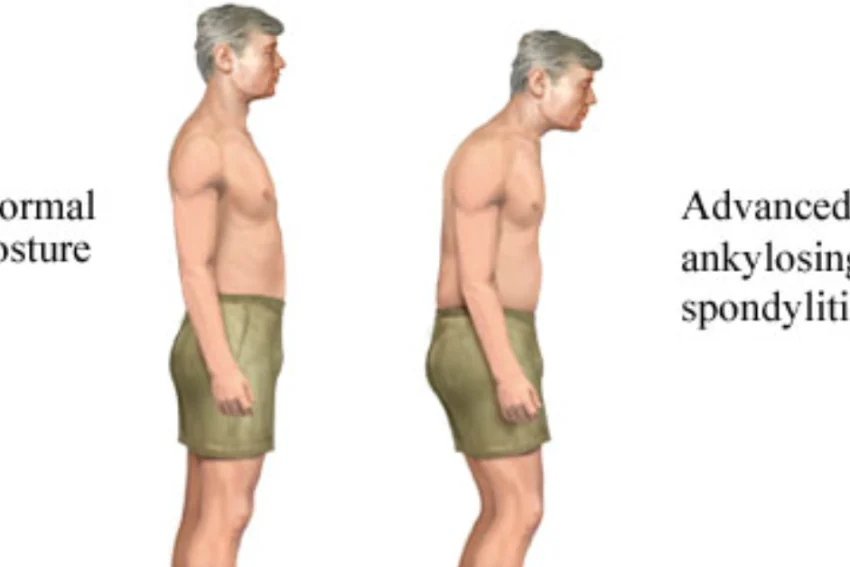 Visual representation of Ankylosing Spondylitis treatment at our Chandigarh-based physiotherapy clinic