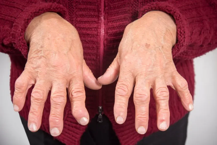 Image illustrating treatment for Boutonniere Deformity at our Chandigarh-based physiotherapy clinic