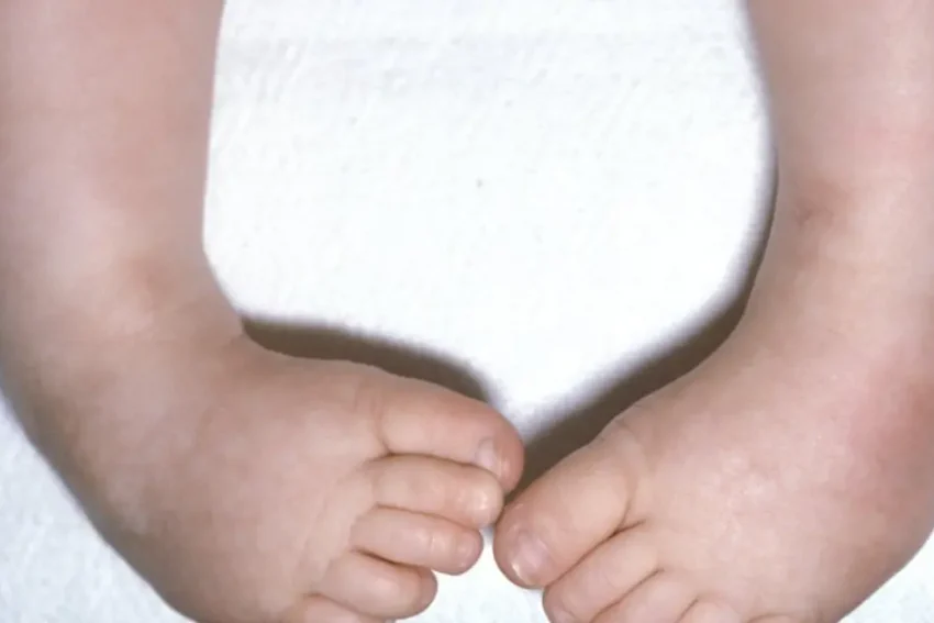 Image depicting treatment for Clubfoot at our Life Chandigarh-based physiotherapy clinic