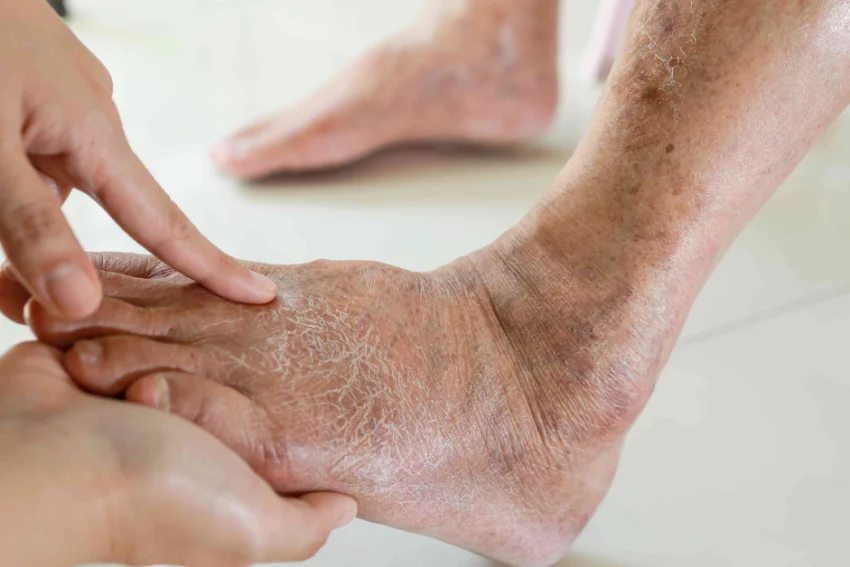 Image illustrating Diabetic Foot treatment at our Chandigarh-based physiotherapy clinic