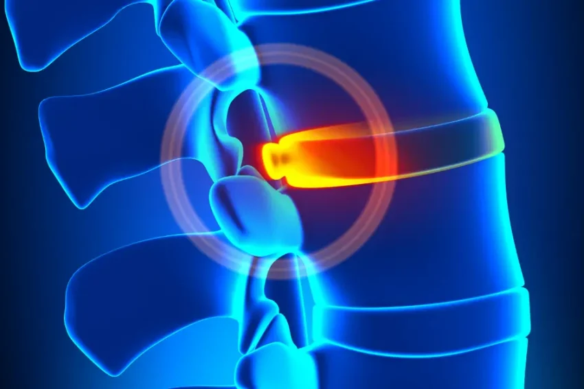 Image illustrating treatment options for Disc Bulge at our Chandigarh-based physiotherapy clinic