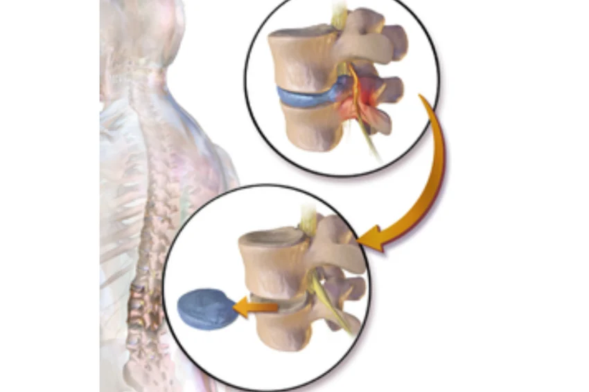 Image illustrating Discectomy treatment at our Chandigarh-based physiotherapy clinic.