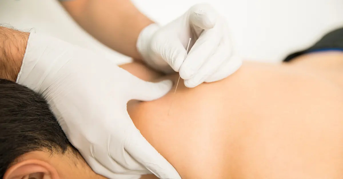 Image showcasing Dry Needling Therapy at our Chandigarh-based life physiotherapy clinic