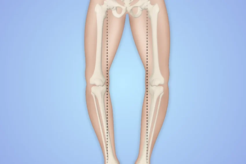 Image depicting treatment for Genu Varum at our Chandigarh-based physiotherapy clinic