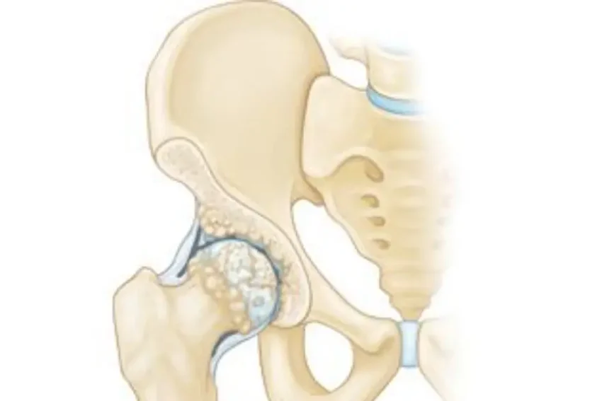 Image featuring treatment for Hip Osteoarthritis at our Chandigarh-based physiotherapy clinic