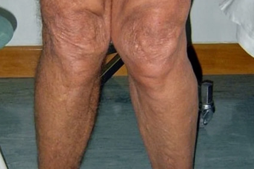 Image illustrating Knee-Osteoarthritis treatment at our Chandigarh-based physiotherapy clinic