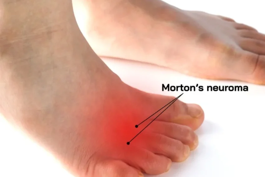 Image showcasing Morton's Neuroma treatment at our Chandigarh-based physiotherapy clinic