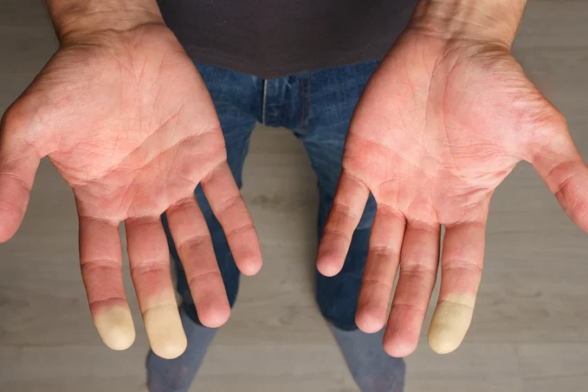 Image illustrating treatment for Raynaud’s Disease at our Chandigarh-based physiotherapy clinic