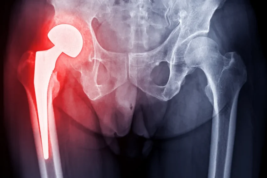 Image showcasing Total Hip Replacement (THR) therapy at our Chandigarh-based physiotherapy clinic