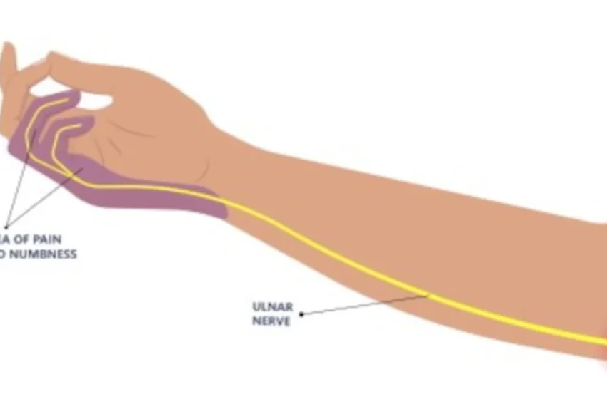 Image highlighting Ulnar Nerve Injury treatment at our Chandigarh-based physiotherapy clinic