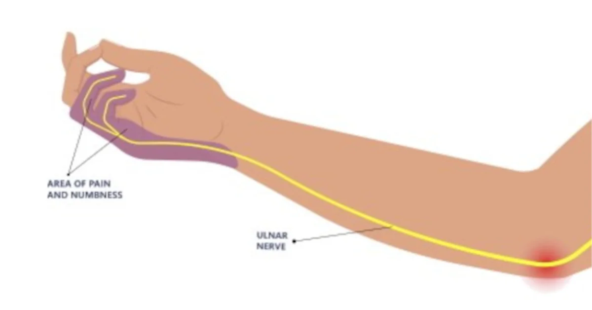 Ulnar Nerve Injury Life Physiotherapy Clinic
